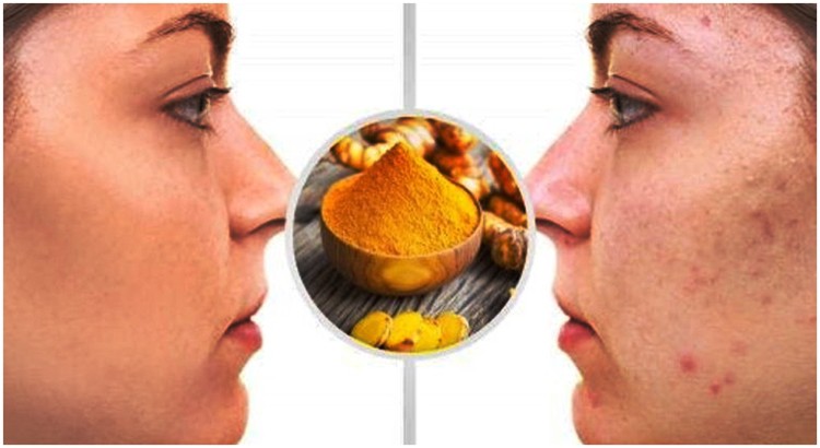 Mascara de açafrão para eliminar cicatrizes de acne: como fazer e receitas