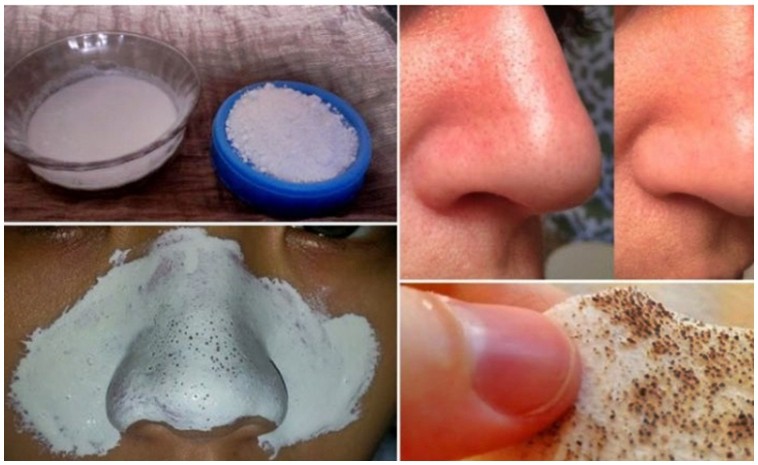Como usar bicarbonato de sódio para eliminar cravos do nariz